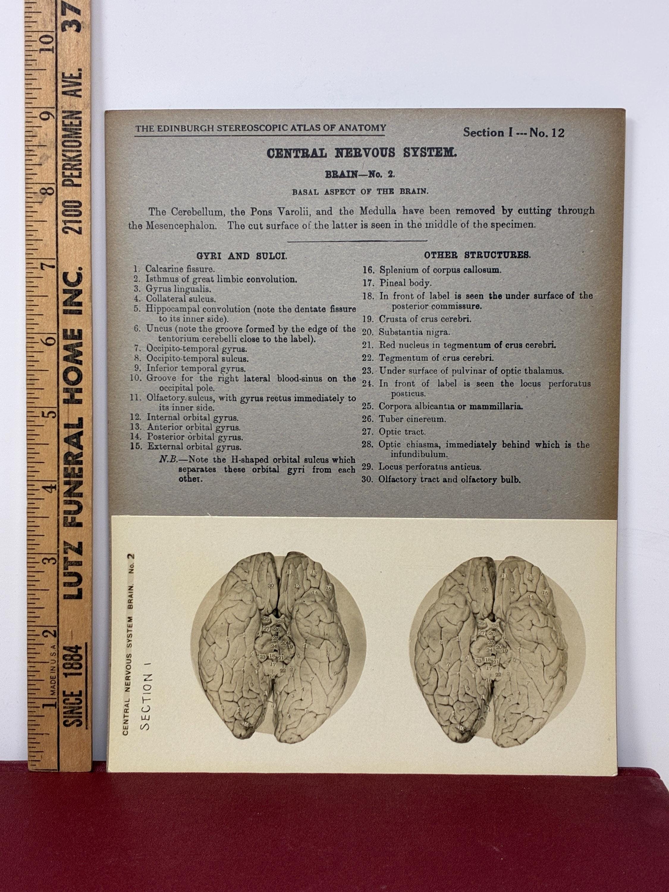 1905 Human Brain Dissection Medical Stereoview Card - Central Nervous ...