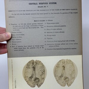 1905 Human Brain Dissection Medical Stereoview Card - Central Nervous System - Brain Number 7