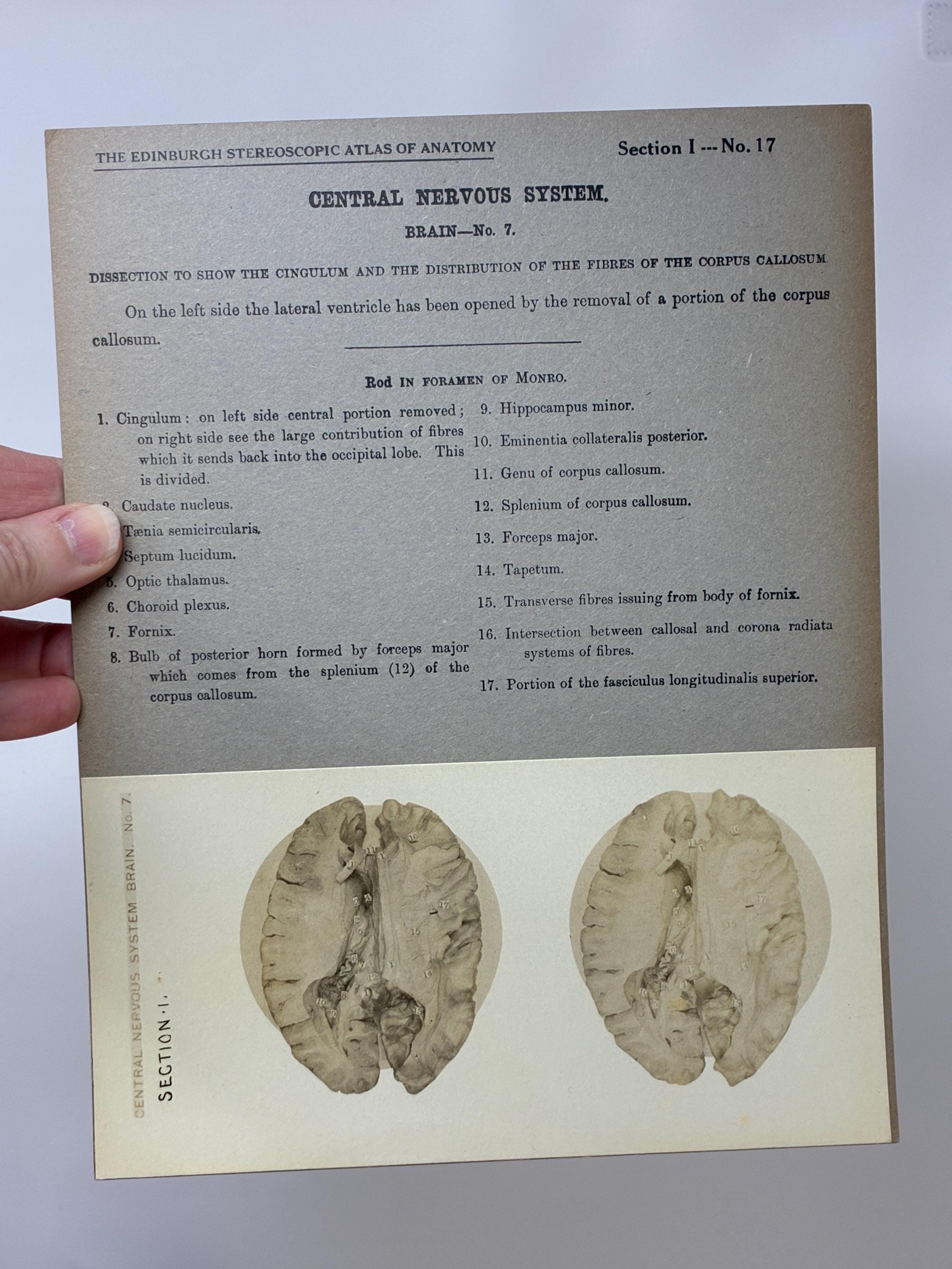 1905 Human Brain Dissection Medical Stereoview Card - Central Nervous ...