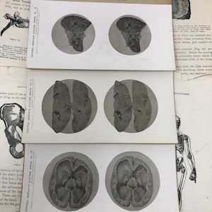 SCEGLI TU! Scheda stereoscopica medica del 1905 con dissezione del cervello umano - Sistema nervoso centrale - Cosplay, oggetti di scena cinematografici, curiosità, collezione medica