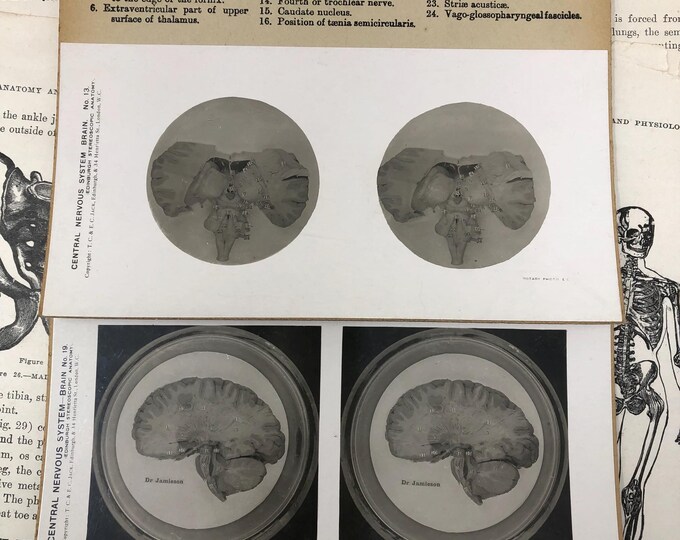 LAST ONE! 1905 Human Brain Dissection Medical Stereoview Card - Central ...