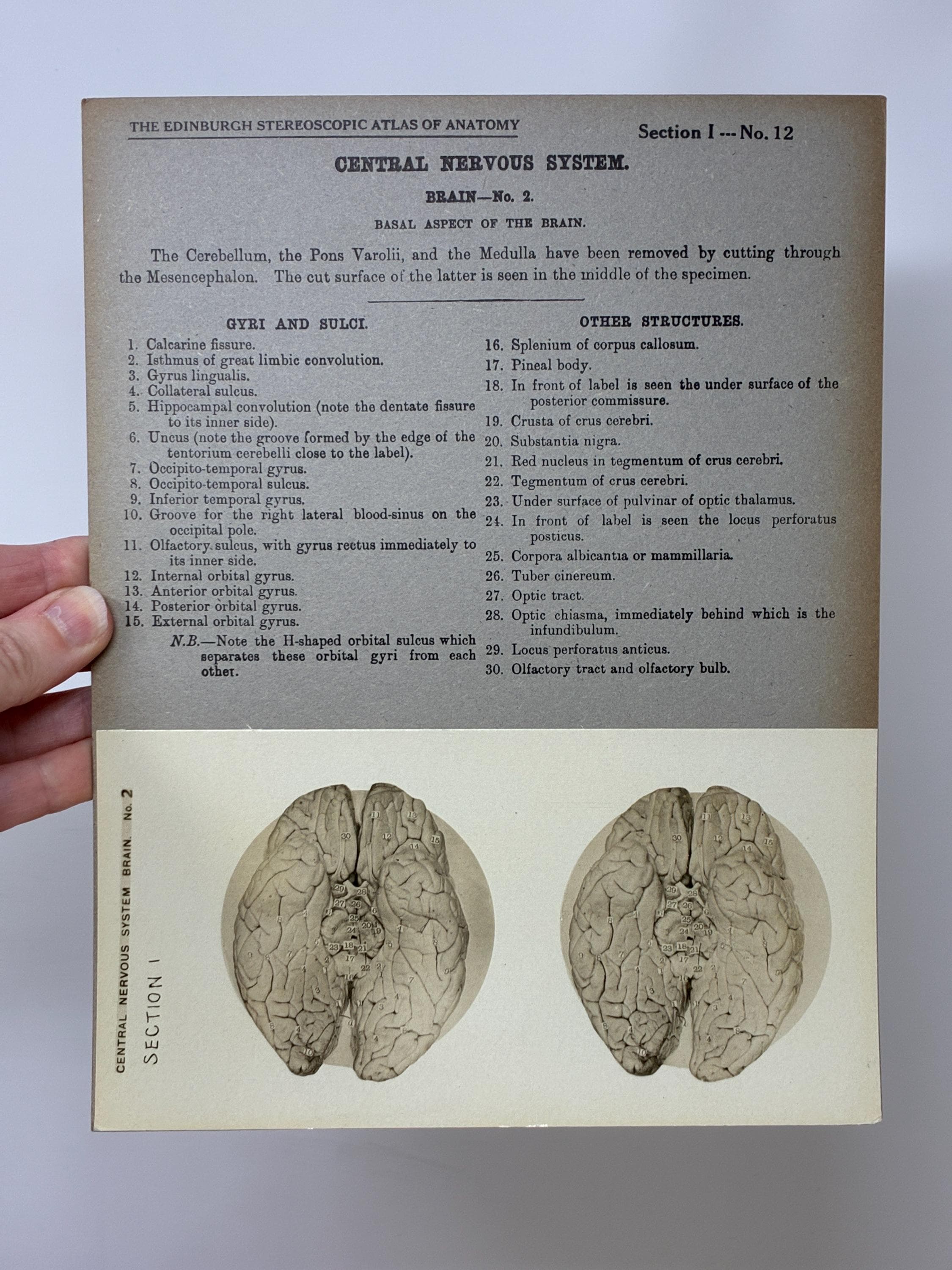 1905 Human Brain Dissection Medical Stereoview Card - Central Nervous ...
