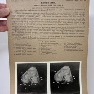 1905 Human Leg & Foot Dissection Medical Stereoview Card - Lower Limb Articulations Knee Joint Number 5