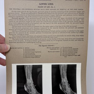 1905 Human Leg & Foot Dissection Medical Stereoview Card Front - Lower Limb Front of Leg Number 1