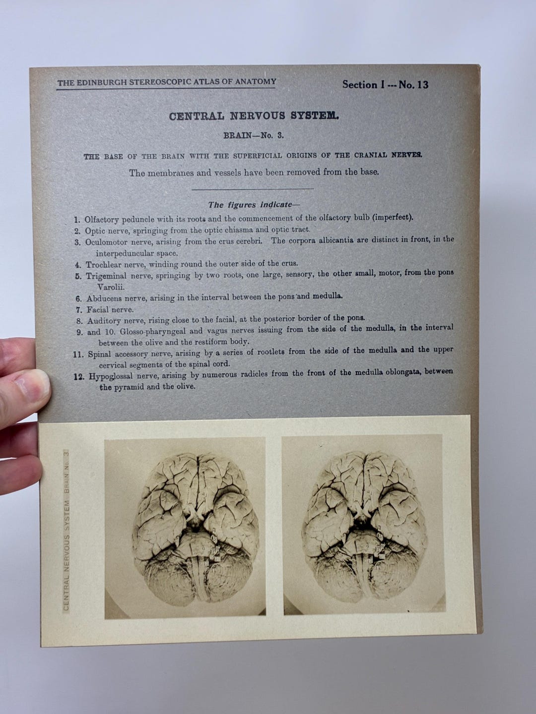 1905 Human Brain Dissection Medical Stereoview Card - Central Nervous ...