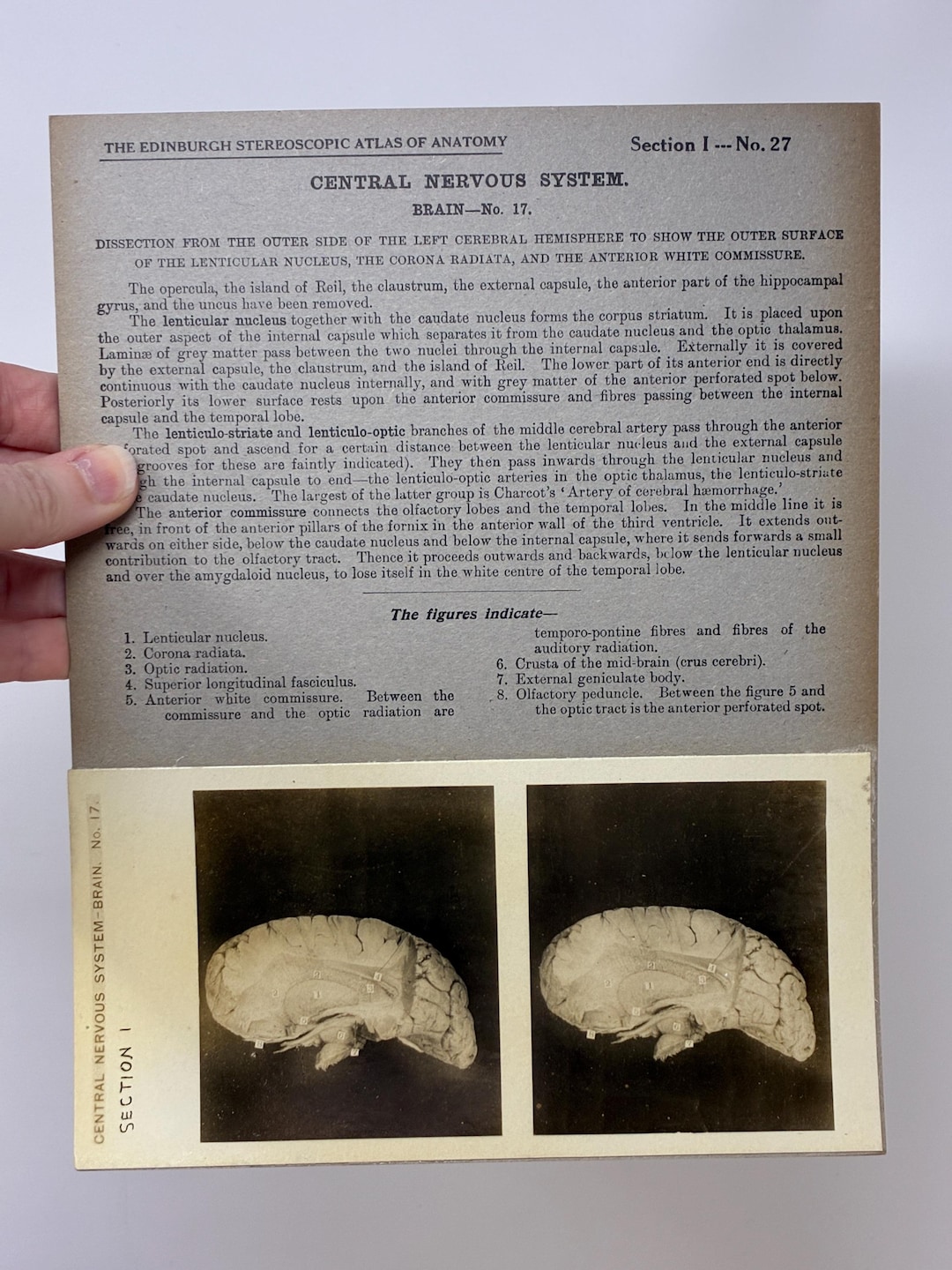 1905 Human Brain Dissection Medical Stereoview Card - Central Nervous ...