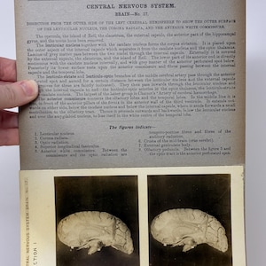 May include: Vintage anatomical illustration from the Edinburgh Stereoscopic Atlas of Anatomy, featuring a dissection of the left cerebral hemisphere. The image shows the lenticular nucleus, corona radiata, and anterior white commissure. The text provides detailed anatomical descriptions.