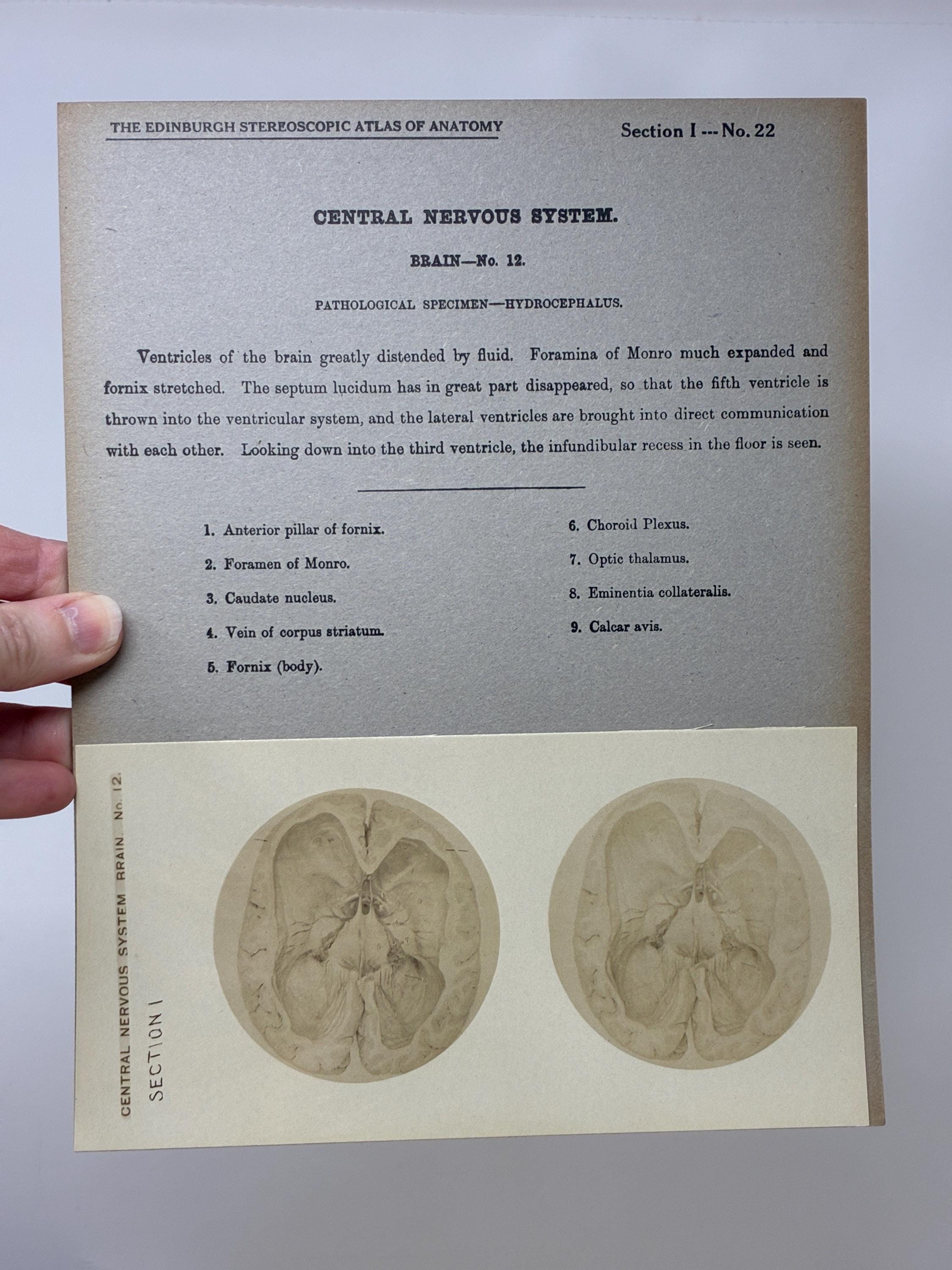 1905 Human Brain Dissection Medical Stereoview Card - Central Nervous ...