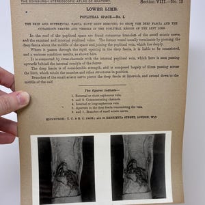 May include: Anatomy illustration from the Edinburgh Stereoscopic Atlas, featuring a detailed diagram of the lower limb's popliteal space. The text describes the nerves and veins, with labeled figures and a black and white image.