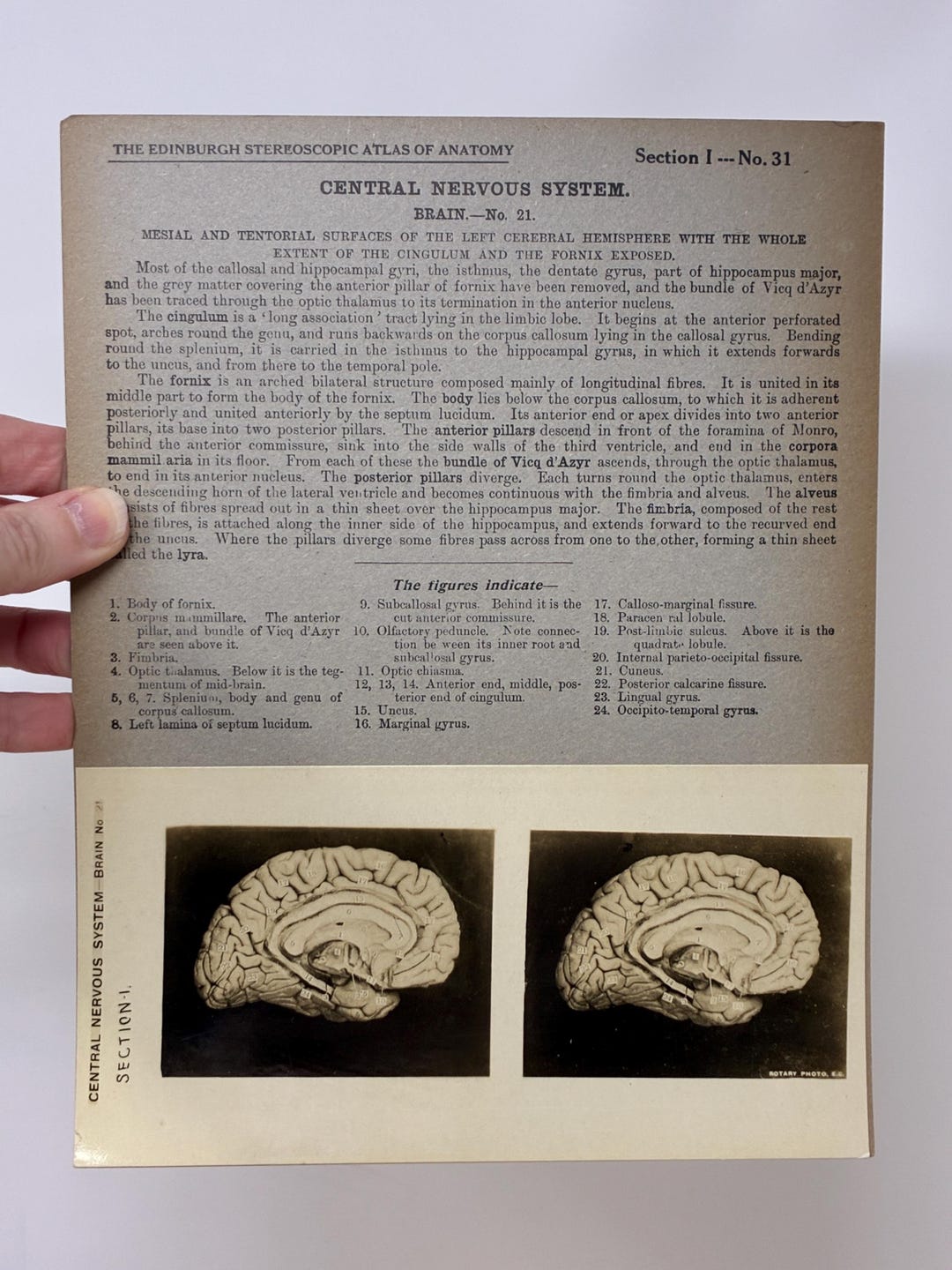 1905 Human Brain Dissection Medical Stereoview Card - Central Nervous ...