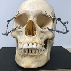 May include: A human skull with teeth, a nasal cavity, and eye sockets. The skull is wearing a surgical instrument with metal clamps.