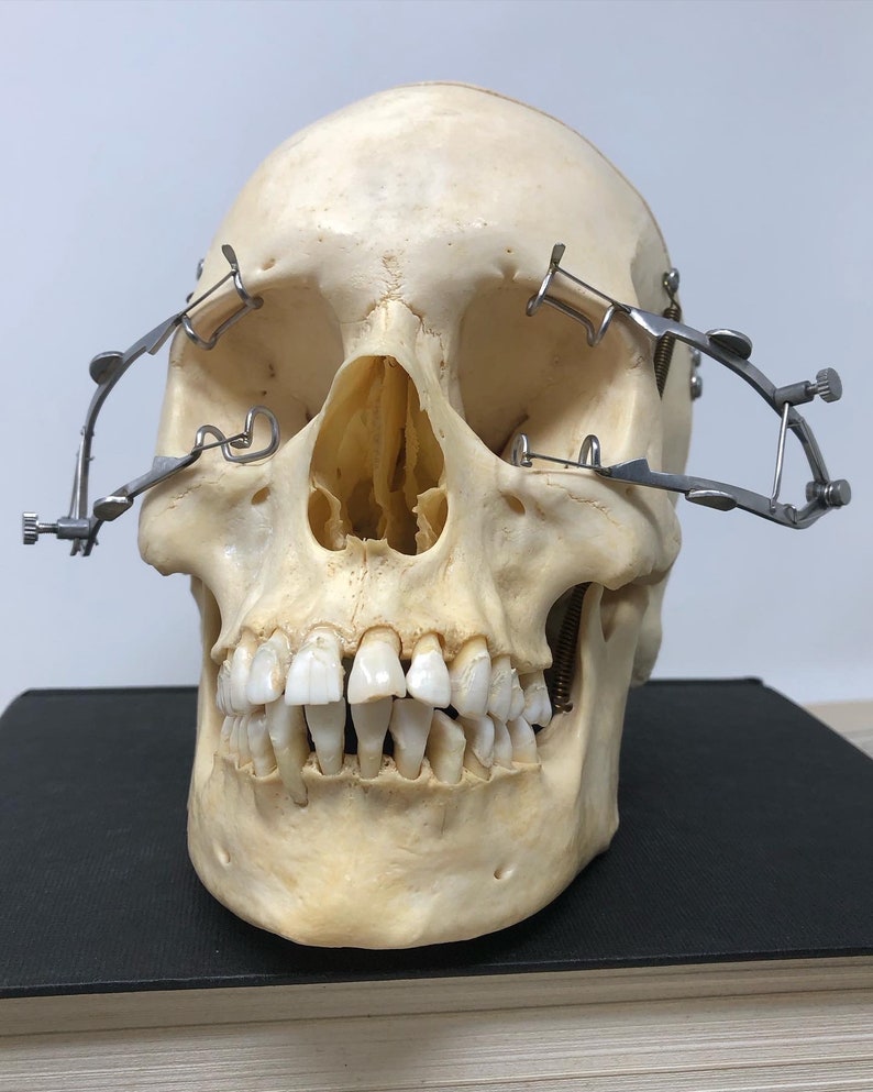 May include: A human skull with teeth, a nasal cavity, and eye sockets. The skull is wearing a surgical instrument with metal clamps.