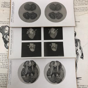 SCEGLI TU! Scheda stereoscopica medica del 1905 con dissezione del cervello umano - Sistema nervoso centrale - Cosplay, oggetti di scena cinematografici, curiosità, collezione medica