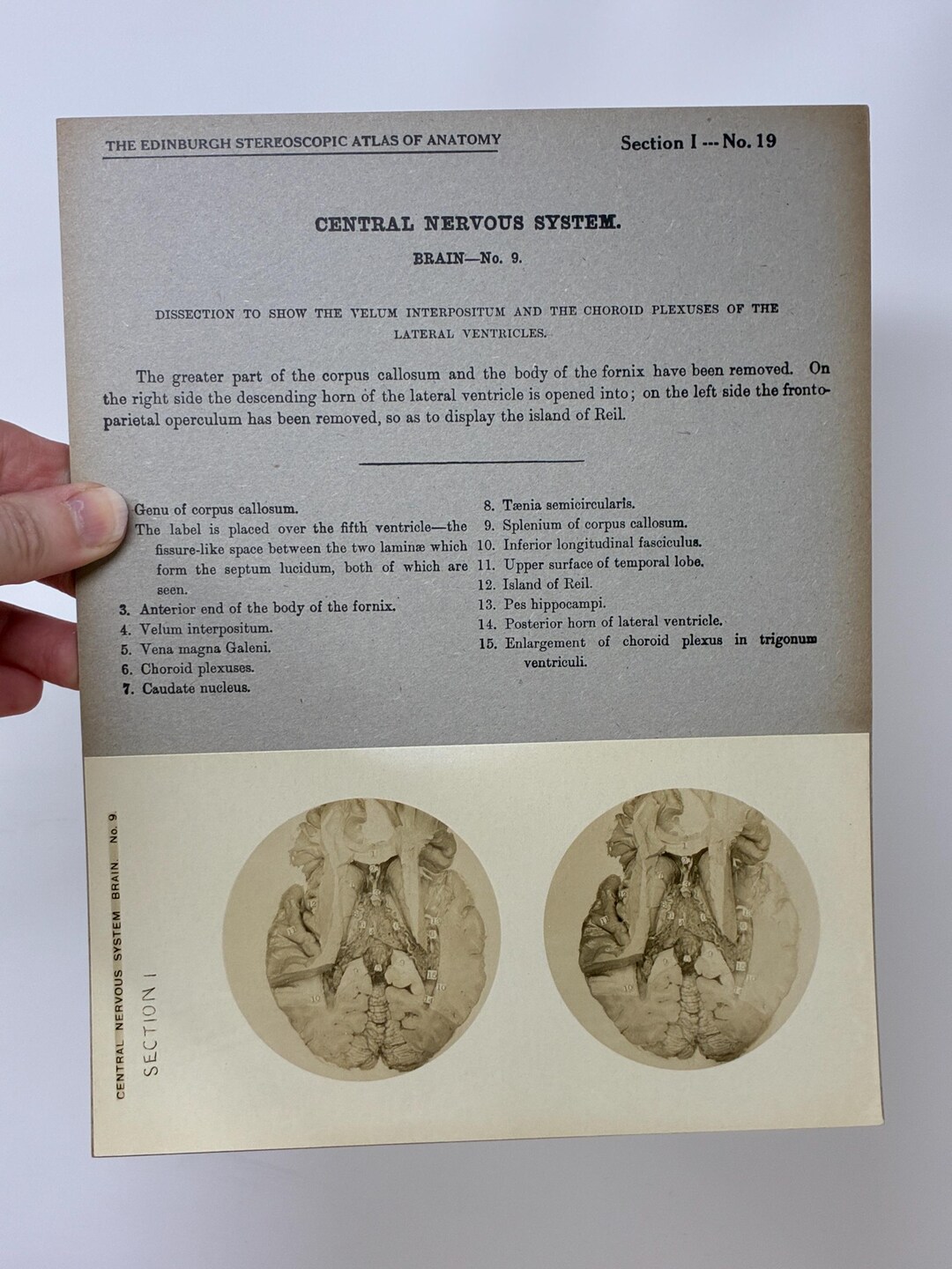 1905 Human Brain Dissection Medical Stereoview Card - Central Nervous ...