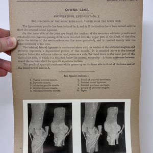 1905 Human Leg & Foot Dissection Medical Stereoview Card - Lower Limb Articulations Knee Joint Number 2