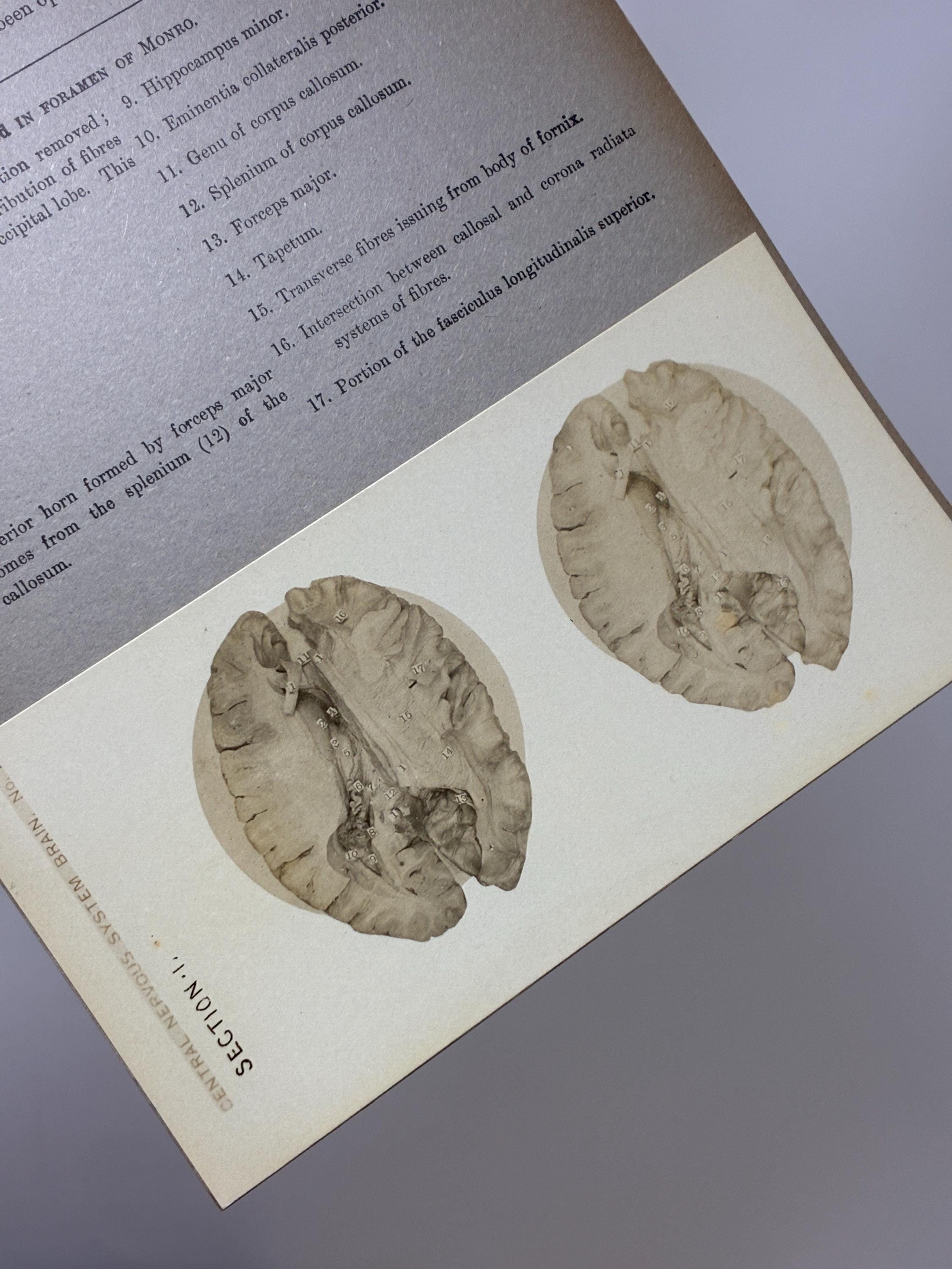 1905 Human Brain Dissection Medical Stereoview Card - Central Nervous ...