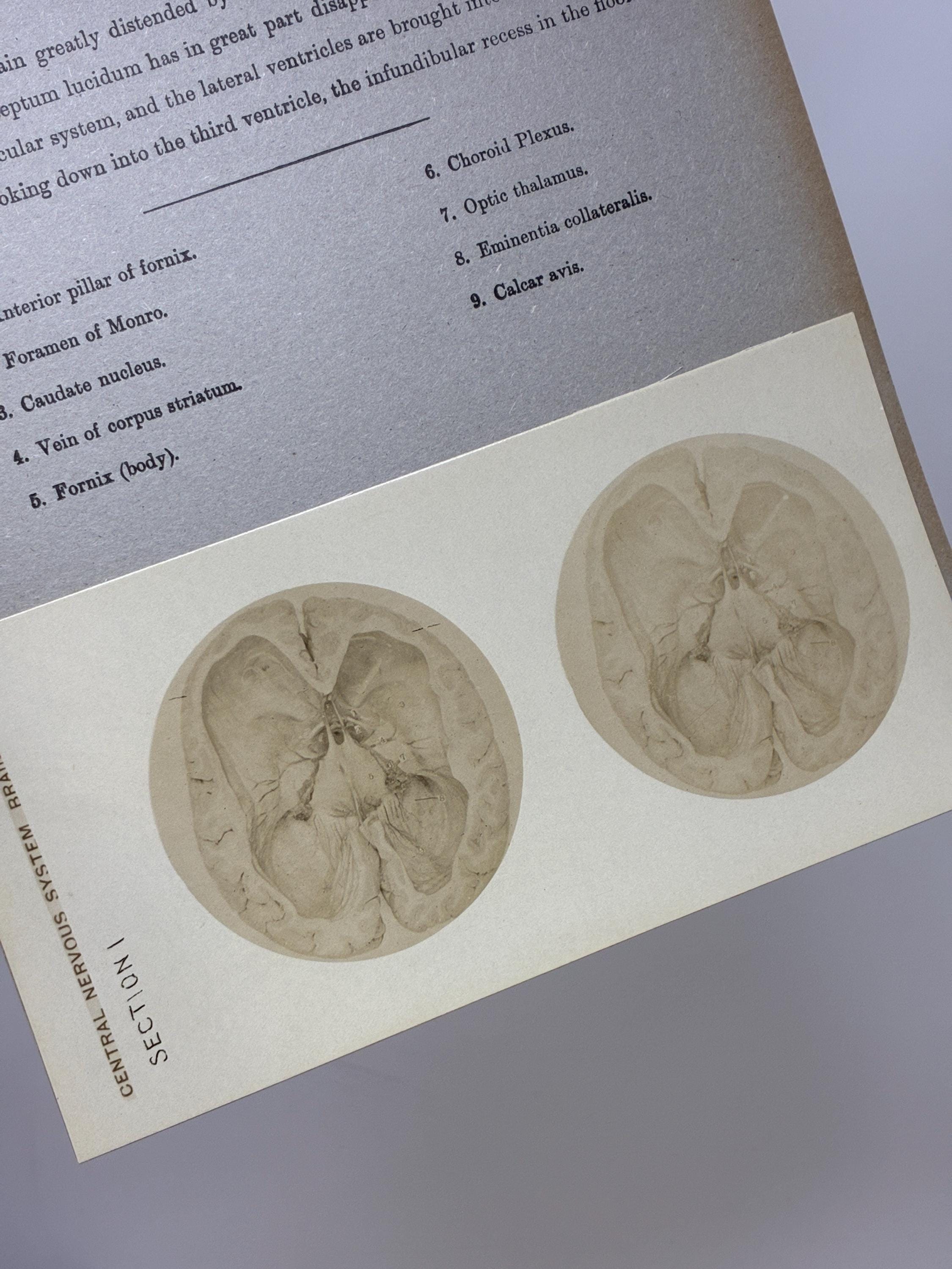 1905 Human Brain Dissection Medical Stereoview Card - Central Nervous ...