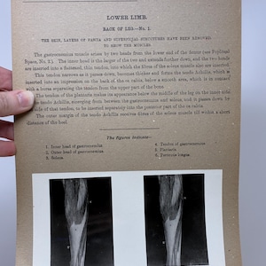 May include: Anatomy illustration from the Edinburgh Stereoscopic Atlas of Anatomy, Section VIII, No. 23. The image shows a detailed black and white diagram of the lower limb, focusing on the back of the leg, with labels and descriptions.