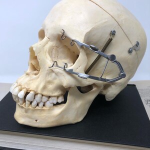 May include: A human skull with teeth, a metal brace, and a spring attached to the side of the skull. The skull is resting on a black book.