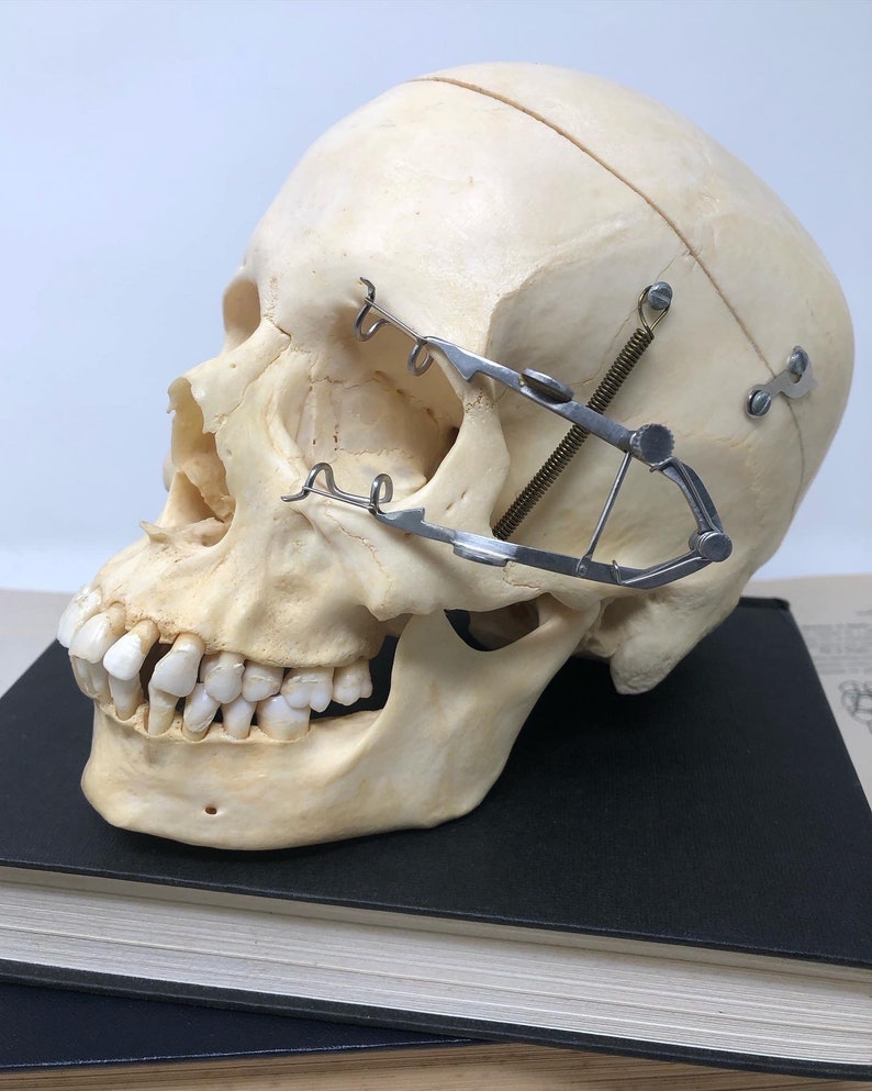May include: A human skull with teeth, a metal brace, and a spring attached to the side of the skull. The skull is resting on a black book.