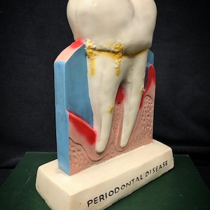 Big Tooth Model Advertising Dental Decay Molar - Dentist Office ...