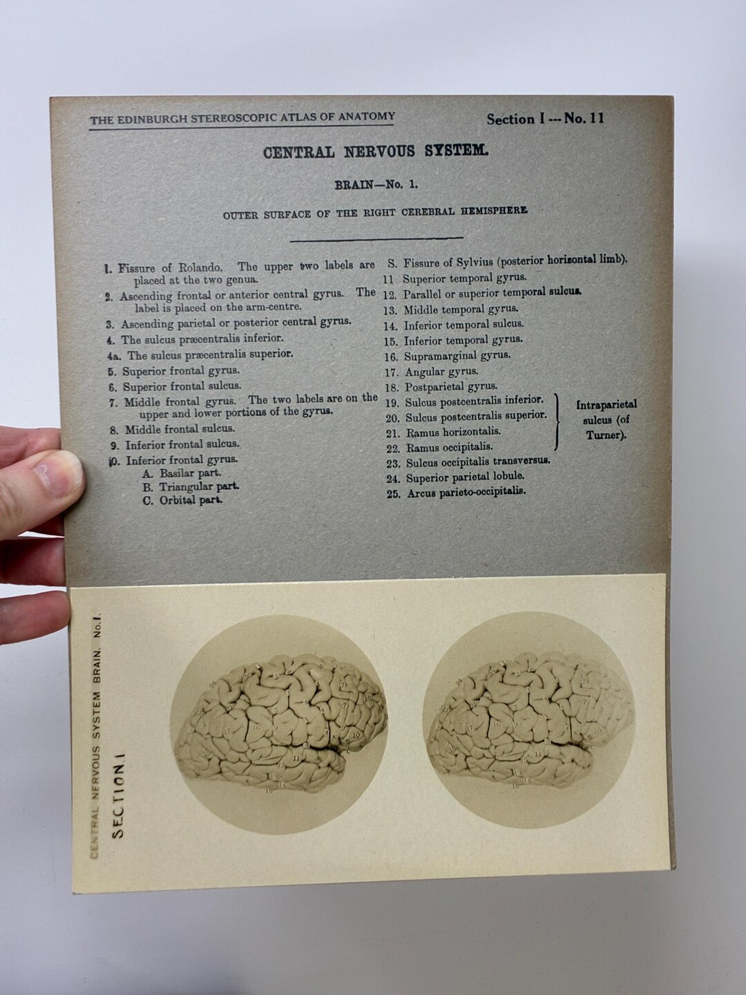 1905 Human Brain Dissection Medical Stereoview Card - Central Nervous ...