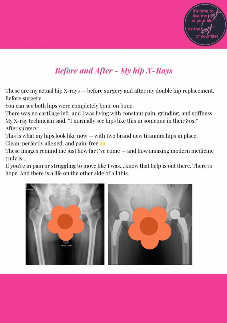 Hip Replacement Recovery Guide for Women – Pain Relief, Post-surgery ...
