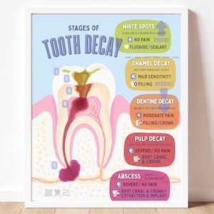 May include: A framed educational poster titled Stages of Tooth Decay, featuring a cross-section illustration of a tooth with numbered stages. The chart details white spots, enamel decay, dentine decay, pulp decay, and abscess with associated symptoms.