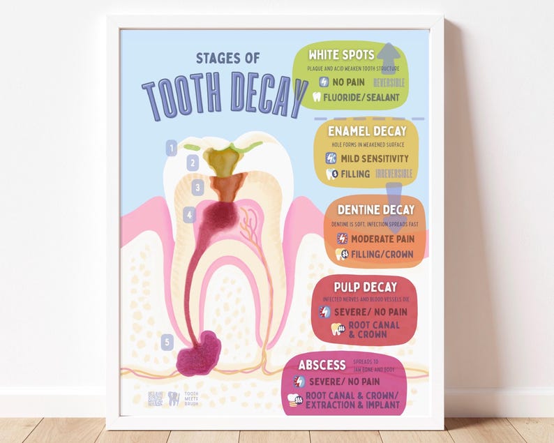 May include: A framed educational poster titled Stages of Tooth Decay, featuring a cross-section illustration of a tooth with numbered stages. The chart details white spots, enamel decay, dentine decay, pulp decay, and abscess with associated symptoms.