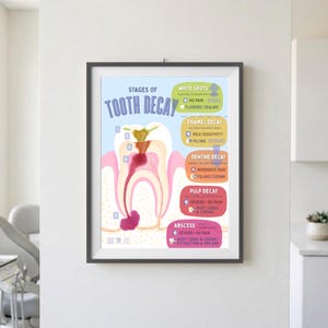 May include: A framed educational poster titled STAGES OF TOOTH DECAY, illustrating the progression from white spots to abscess. The diagram features a cross-section of a tooth with colour-coded sections for enamel, dentine, pulp, and abscess stages.