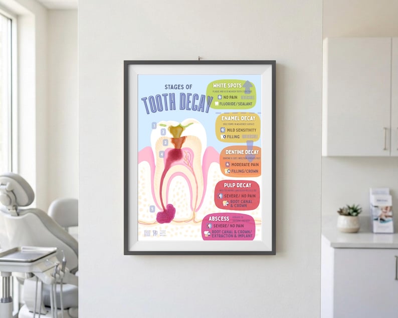 May include: A framed educational poster titled STAGES OF TOOTH DECAY, illustrating the progression from white spots to abscess. The diagram features a cross-section of a tooth with colour-coded sections for enamel, dentine, pulp, and abscess stages.