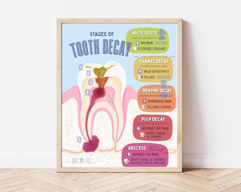 Cavity Progression Wall Art, Tooth Anatomy Educational Poster, Oral Health Dental Clinic Decor image 1