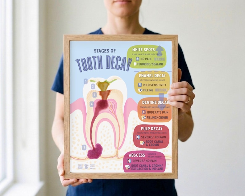 May include: A framed educational poster titled Stages of Tooth Decay, featuring a cross-section illustration of a tooth with numbered decay progression. The chart details five stages including white spots, enamel, dentine, pulp decay, and abscess.