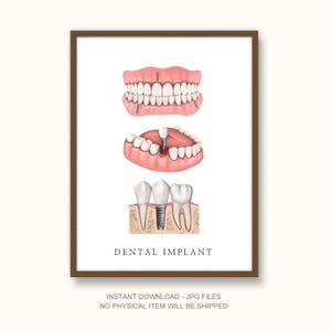 Póster de anatomía dental y estructura de implantes, descarga digital, impresión artística anatómica