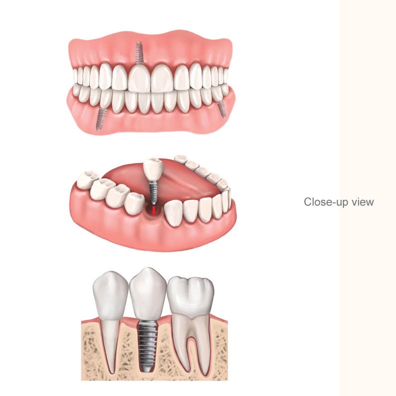 Dental Implant & Human Teeth Anatomy Poster Set: Medical Illustration ...