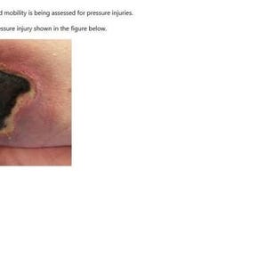 May include: Image of a pressure injury on skin, with a dark, crater-like center surrounded by inflamed tissue. The image is part of an assessment for a 72-year-old client with limited mobility. Options for staging the injury are provided.