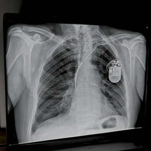 Könnte beinhalten: Röntgenbild des menschlichen Brustkorbs in Graustufen, das Rippen, Lungen und ein medizinisches Gerät zeigt. Das Gerät befindet sich auf der rechten Seite der Brust und ist durch einen Draht verbunden.