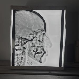 Peut inclure: Radiographie en noir et blanc d'un crâne humain de profil, présentée dans un cadre en bois. L'image révèle la structure osseuse détaillée du crâne et de la mâchoire, avec la colonne vertébrale visible. L'image est éclairée par l'arrière.