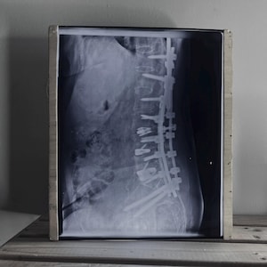 Könnte beinhalten: Röntgenbild einer menschlichen Wirbelsäule mit Metallimplantaten, präsentiert in einem Holzrahmen. Das Bild zeigt die innere Struktur der Wirbelsäule und die zur Unterstützung verwendete Hardware. Der Rahmen ist rechteckig und aus hellem Holz.