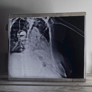 Puede incluir: Imagen de rayos X en blanco y negro de un tórax humano, que muestra la caja torácica, la columna vertebral y un dispositivo médico. La imagen está enmarcada en un borde metálico y descansa sobre una superficie de madera.