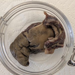 May include: A preserved organ specimen, possibly a liver, presented in a clear glass jar. The organ exhibits a combination of brown, tan, and reddish-purple colours. The jar rests on a white, textured surface.
