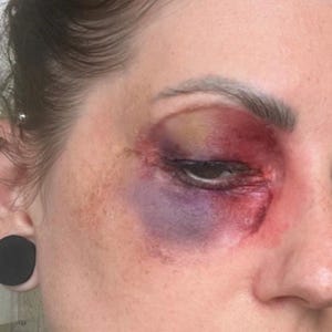 May include: Close-up of a person's eye with a prominent black eye. The area around the eye is bruised with shades of purple, red, and yellow. The skin shows signs of trauma.