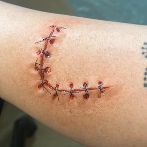 Può includere: Primo piano di una ferita suturata sul braccio. La ferita è una linea curva di punti di sutura con sangue visibile e filo nero. La pelle intorno alla ferita è rossa e irritata.