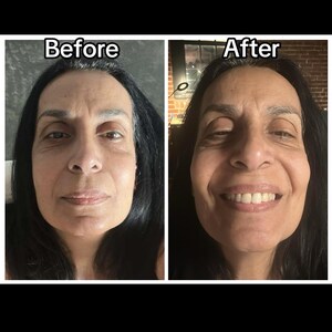 May include: A split image shows a woman's face before and after a treatment. The left side shows a neutral expression, while the right side displays a smiling face. The text "Before" and "After" are above each image.