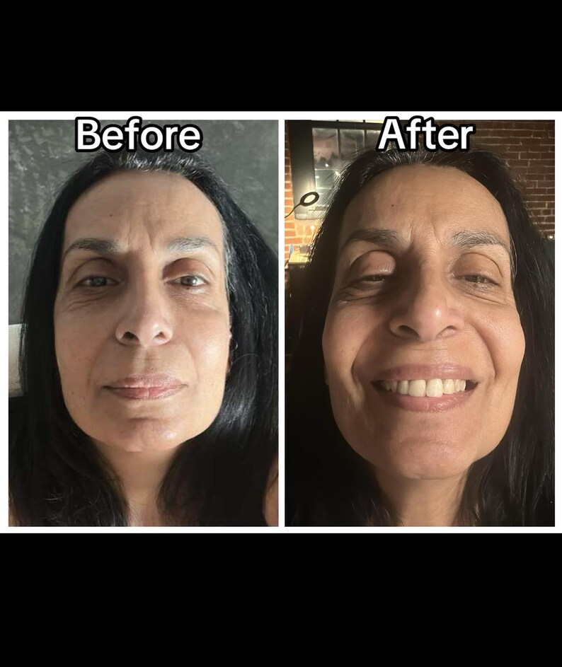 May include: A split image shows a woman's face before and after a treatment. The left side shows a neutral expression, while the right side displays a smiling face. The text "Before" and "After" are above each image.