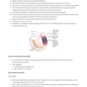 Peut inclure: Sch&eacute;ma m&eacute;dical illustrant l'infarctus du myocarde et les syndromes coronariens aigus. L'image comprend un diagramme du c&oelig;ur avec des zones de l&eacute;sion et d'isch&eacute;mie, ainsi que du texte expliquant les conditions et les sympt&ocirc;mes associ&eacute;s.