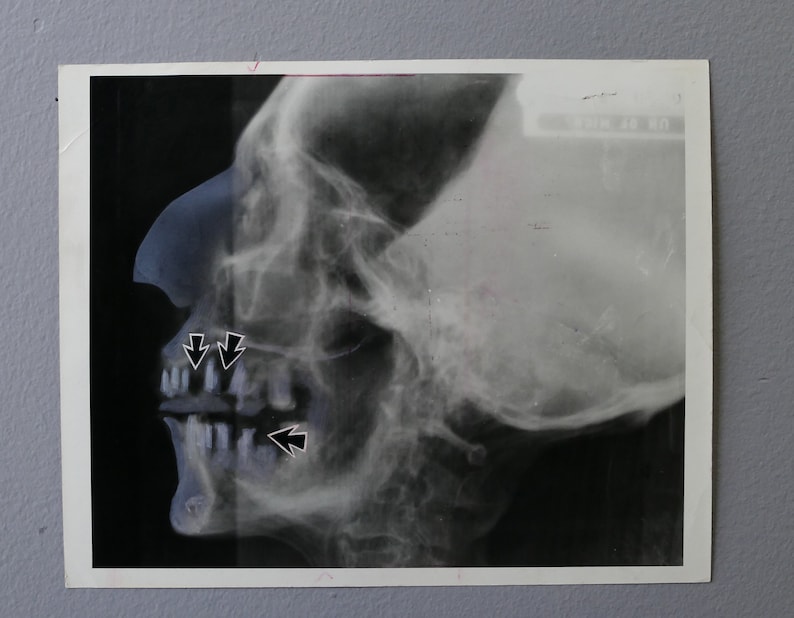 Ramses II Egyptian Mummy Original Press Photo Oddities Unique Strange Dental Xray Photo