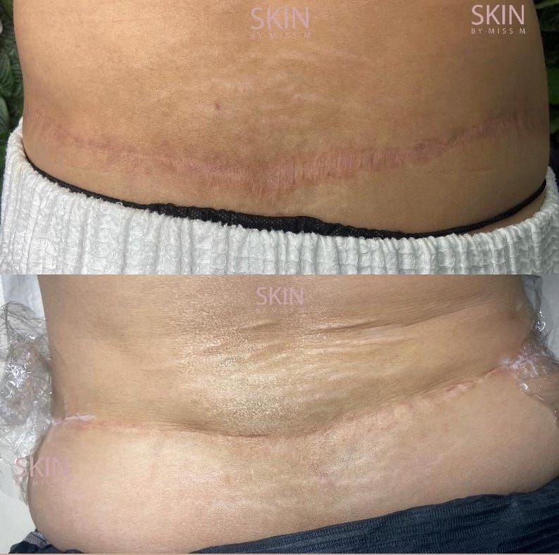 May include: Two images showing a person's abdomen with a scar. The top image shows a scar with a reddish hue. The bottom image shows the same area with a less visible scar. The word "SKIN" is visible in the top right and bottom left corners.