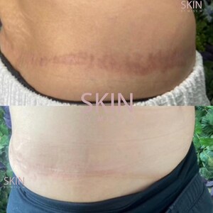 May include: A before-and-after image of skin, showing a reduction in the appearance of stretch marks. The top image shows prominent, reddish-purple marks. The bottom image shows a significant improvement, with marks appearing lighter. The text "SKIN by Miss M" is visible.