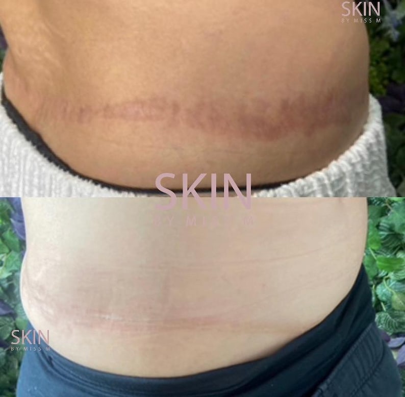 May include: A before-and-after image of skin, showing a reduction in the appearance of stretch marks. The top image shows prominent, reddish-purple marks. The bottom image shows a significant improvement, with marks appearing lighter. The text "SKIN by Miss M" is visible.